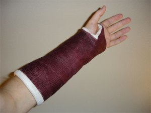 a broken arm